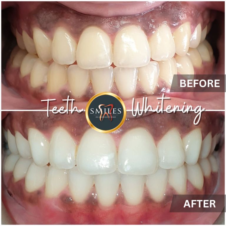 Whitening, Composite bonding, dentist in leeds, emergency dentist