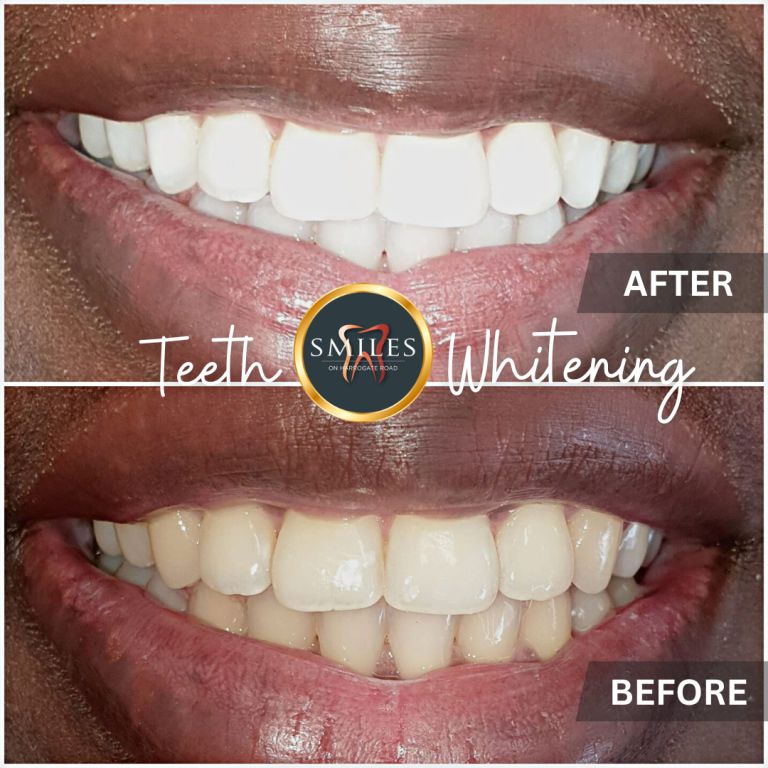Whitening, Composite bonding, dentist in leeds, emergency dentist