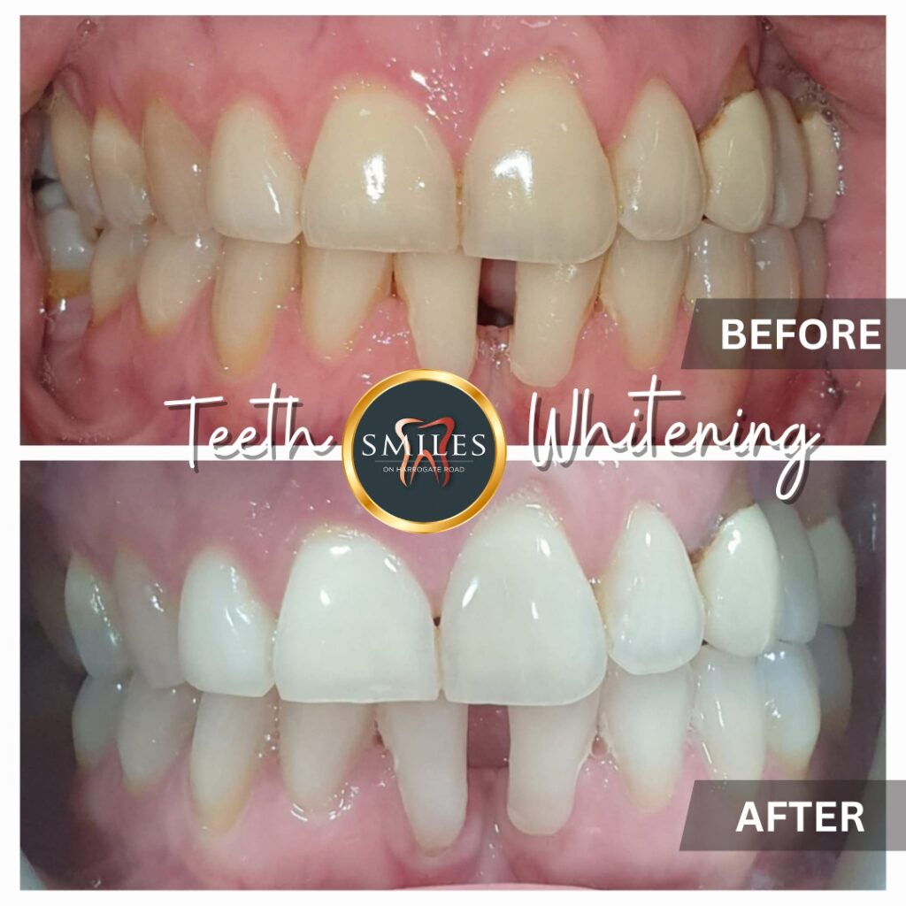 Teeth Whitening